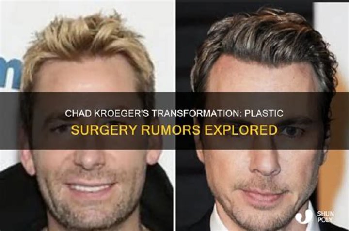 Chad Kroeger’s Plastic Surgery The 48YearOld Canadian Singer’s
