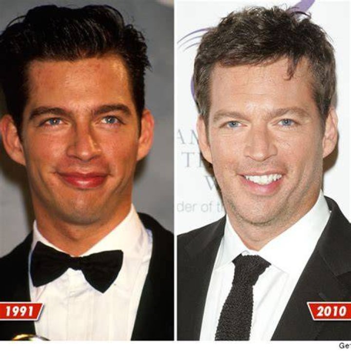 Understand Harry Connick Jr.'s Stroke: Symptoms, Impact, And Recovery